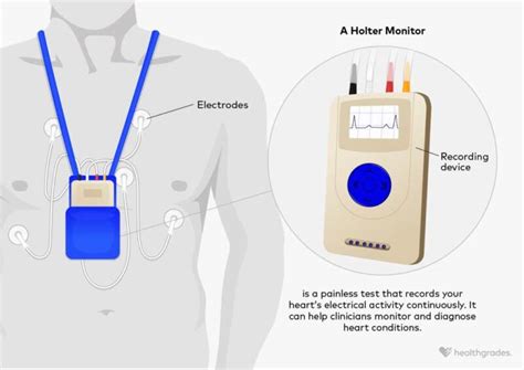 Holter Monitor: Why It's Done, and What to Expect.